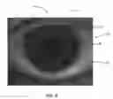 Fig. 09 - Ocular surface interferometry (OSI) methods for imaging and measuring ocular tear film layer thickness(es)