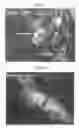 Fig. 02 - Therapy using cardiac stem cells and mesenchymal stem cells