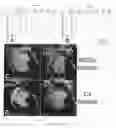 Fig. 22 - Therapy using cardiac stem cells and mesenchymal stem cells