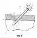Fig. 02 - BENDABLE VERESS NEEDLE ASSEMBLY