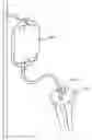Fig. 01 - Method and device for delivering medicine to bone
