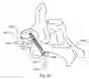 Fig. 28 - Method and device for delivering medicine to bone