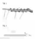 Fig. 03 - Spiral balloon catheter