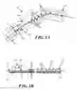 Fig. 02 - Methods and devices for applying closed incision negative pressure wound therapy