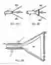 Fig. 09 - Breast surgery method and apparatus