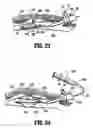 Fig. 09 - Balloon dissection apparatus