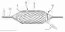 Fig. 01 - Non-shortening high angle wrapped balloons