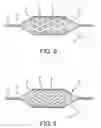 Fig. 06 - Non-shortening high angle wrapped balloons