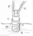 Fig. 01 - TWIST-IN SUTURE ANCHOR