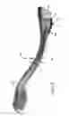 Fig. 07 - Clavicle nail with locking end cap