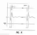 Fig. 06 - Neural stimulation system providing auto adjustment of stimulus output as a function of sensed impedance