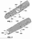 Fig. 02 - Stent having a C-shaped body section for use in a bifurcation