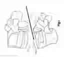 Fig. 02 - Minimally invasive spine augmentation and stabilization system and method