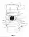 Fig. 13 - Minimally invasive spine augmentation and stabilization system and method