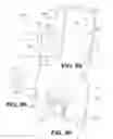 Fig. 44 - Spine distraction implant