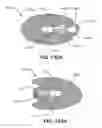 Fig. 79 - Spine distraction implant