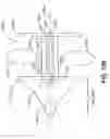 Fig. 86 - Spine distraction implant