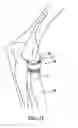 Fig. 07 - Modular prosthesis and use thereof for replacing a radial head
