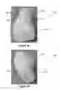 Fig. 04 - Hybrid Closure For Containers