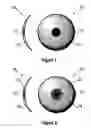 Fig. 02 - Contact lens for treating binocular diplopia