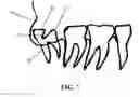 Fig. 08 - DEVICE FOR LOOSENING OR EXTRACTING A WISDOM TOOTH