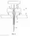 Fig. 03 - Infusion hub assembly and fluid line disconnect system