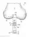 Fig. 01 - Osteochondral implant fixation procedure and bone dilator used in same