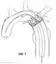 Fig. 10 - Stent Graft Restraining Mechanism for a Delivery System (Catheter)