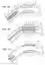 Fig. 02 - Endoprosthese