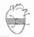 Fig. 01 - Heart wall tension reduction apparatus and method