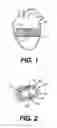 Fig. 02 - Heart wall tension reduction apparatus and method