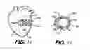 Fig. 08 - Heart wall tension reduction apparatus and method