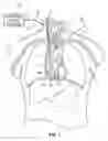 Fig. 02 - Apparatus And Methods for Separating Pericardial Tissue From The Epicardium of the Heart