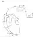 Fig. 01 - Methods for detecting atrial tachyarrhythmia in implantable devices without dedicated atrial sensing