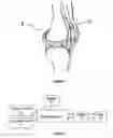Fig. 02 - METHOD AND APPARATUS FOR INTRA-ARTICULAR INJECTION OR ASPIRATION