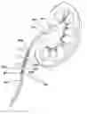 Fig. 01 - RENAL FLUSHING CATHETER