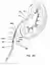 Fig. 06 - RENAL FLUSHING CATHETER