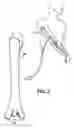 Fig. 02 - Method for repairing fractured bone