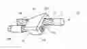 Fig. 01 - System and Method for Minimally Invasive Crimp and Cable for Bone Cerclage