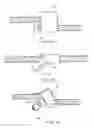 Fig. 06 - System and Method for Minimally Invasive Crimp and Cable for Bone Cerclage