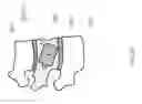 Fig. 08 - Minimally invasive cement delivery system retainer