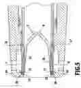 Fig. 06 - Surgical instrument for applying ligating clips