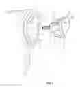 Fig. 02 - Joint prosthesis attachment system, device and method