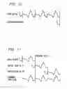 Fig. 09 - Method and apparatus for performing packet loss or frame erasure concealment