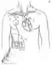 Fig. 01 - Methods, devices and systems for counterpulsation of blood flow to and from the circulatory system