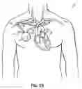 Fig. 03 - Methods, devices and systems for counterpulsation of blood flow to and from the circulatory system