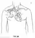 Fig. 04 - Methods, devices and systems for counterpulsation of blood flow to and from the circulatory system