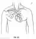 Fig. 05 - Methods, devices and systems for counterpulsation of blood flow to and from the circulatory system