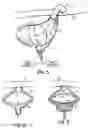 Fig. 09 - Methods, devices and systems for counterpulsation of blood flow to and from the circulatory system