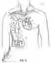 Fig. 12 - Methods, devices and systems for counterpulsation of blood flow to and from the circulatory system